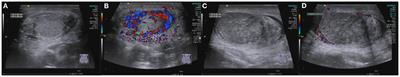 Case Report: Testicular Torsion in Unilateral Supernumerary Testis